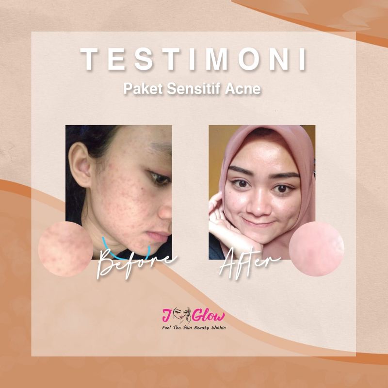 Jglow skincare PAKET SENSITIF WHITENING/ SENSITIF JERAWAT(100% AMPUH MENCERAHKAN KULIT WAJAH YANG SENSITIF)ISI 4 ITEM