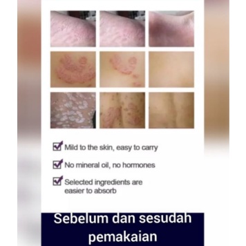 [BEST SELLER] Salep HL Tube Jumbo -  Pi Kang Wang - Salep Gatel / Salep Kulit Cream / Salep Kulit Gatel Jamur-4