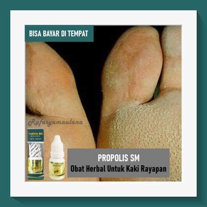 Obat Kaki Rayapan, Kapalan, Obat Herbal Telapak Kaki Berlubang Walatra Propolis SM