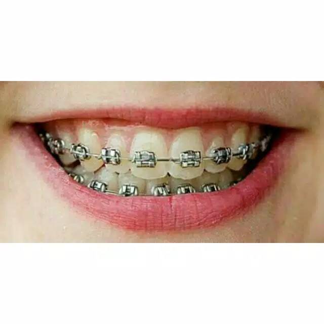 Behel gigi metal silver atas//real pick