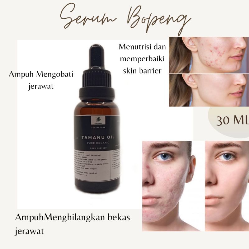 MINYAK TAMANU OIL MURNI 100% Penghilang Bekas Jerawat dan Bopeng 30ml