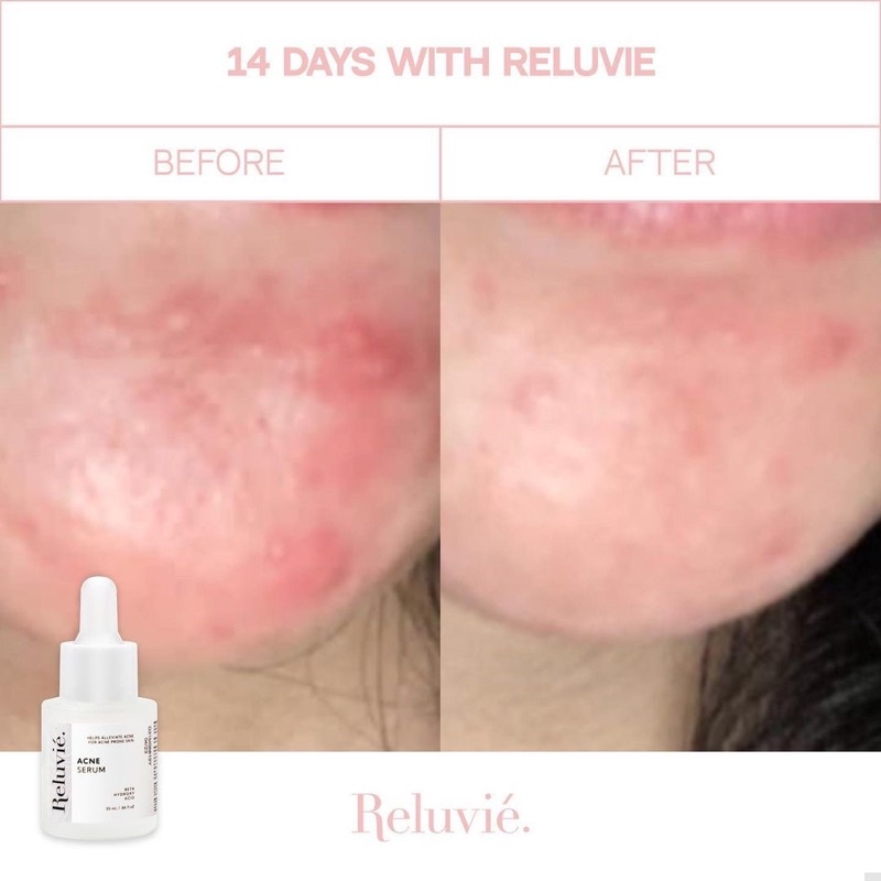 RELUVIE Acne Serum 10ml / 20ml BPOM Serum Jerawat