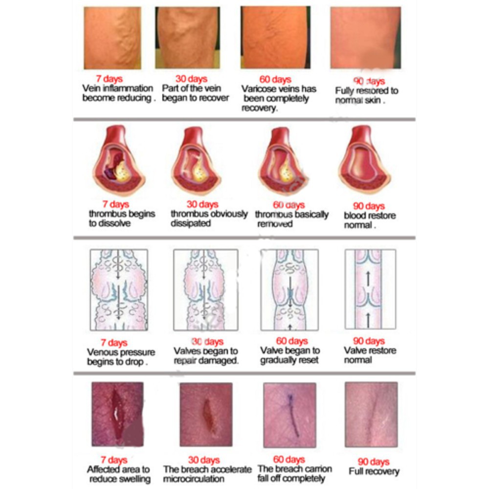 Varice sau vene varicoase: cauze, simptome si tratament | Bioclinica