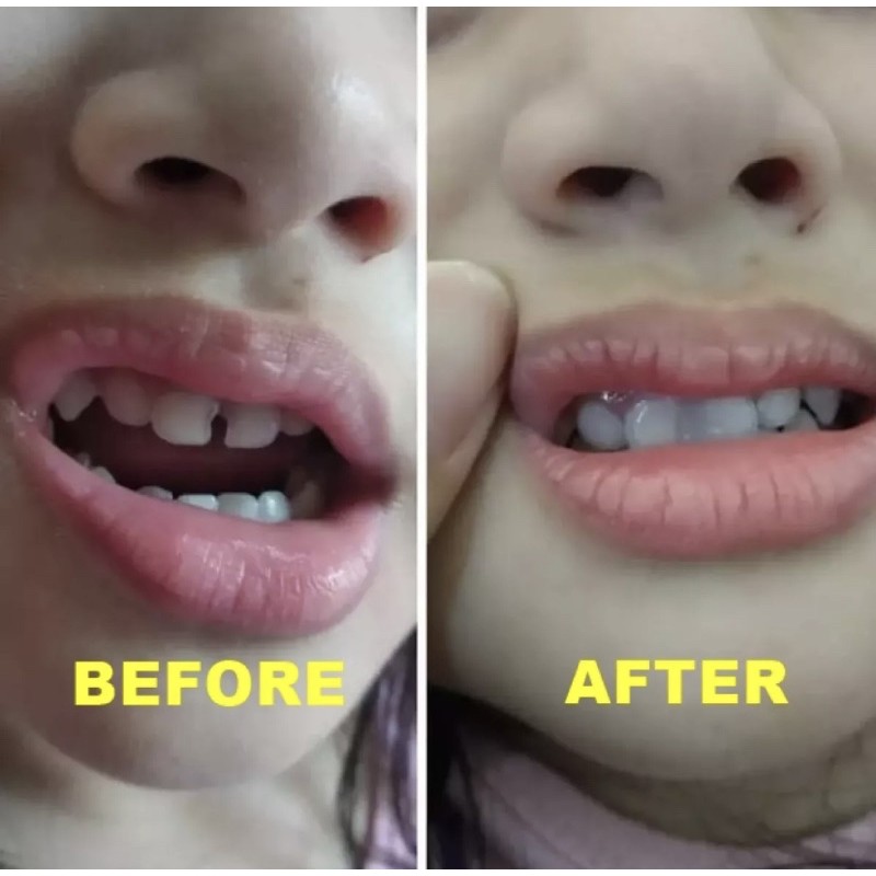 Tempteeth Tambal Gigi Temporary Tooth Penambal Gigi