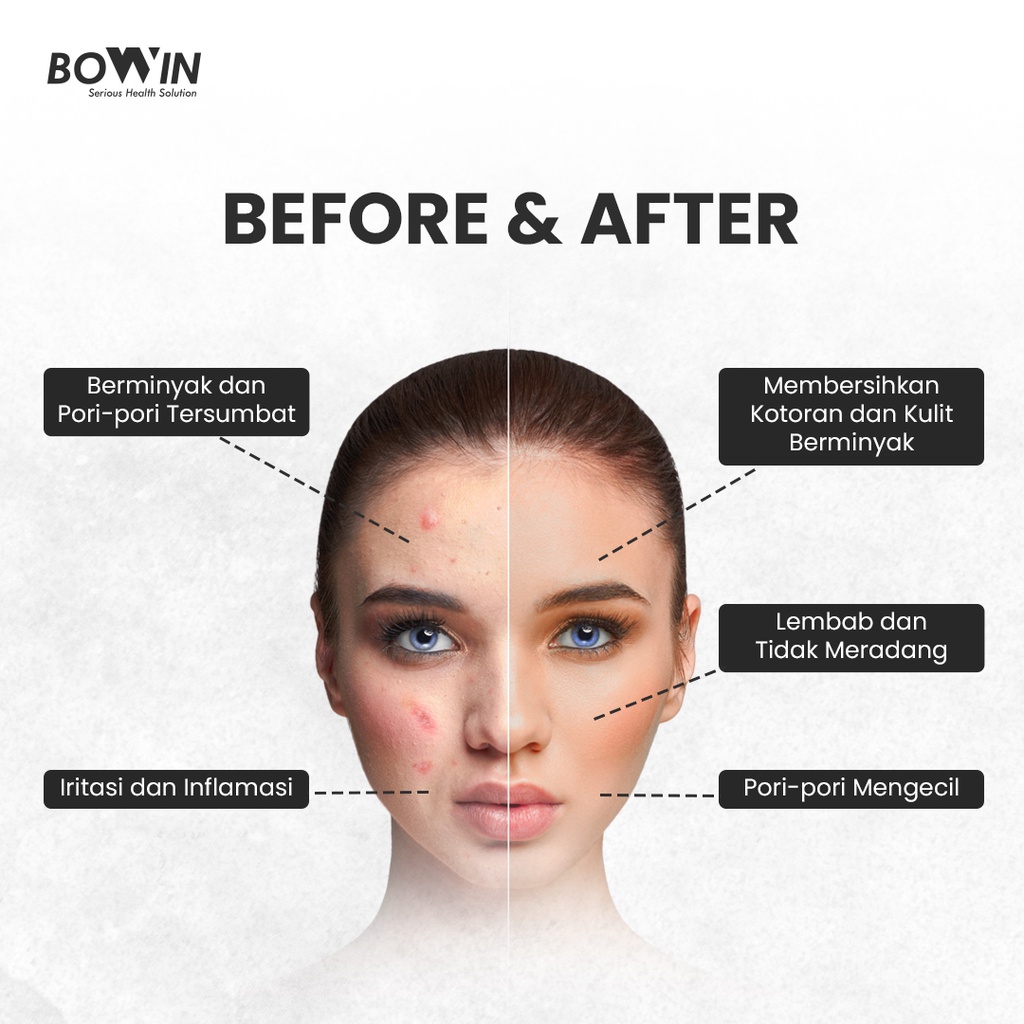 Bowin Acne Spray - Maskne &amp; Back Acne (Centella Asiatica &amp; Allantoin) [Jerawat Wajah, Jerawa Punggung, Jerawat Tubuh]