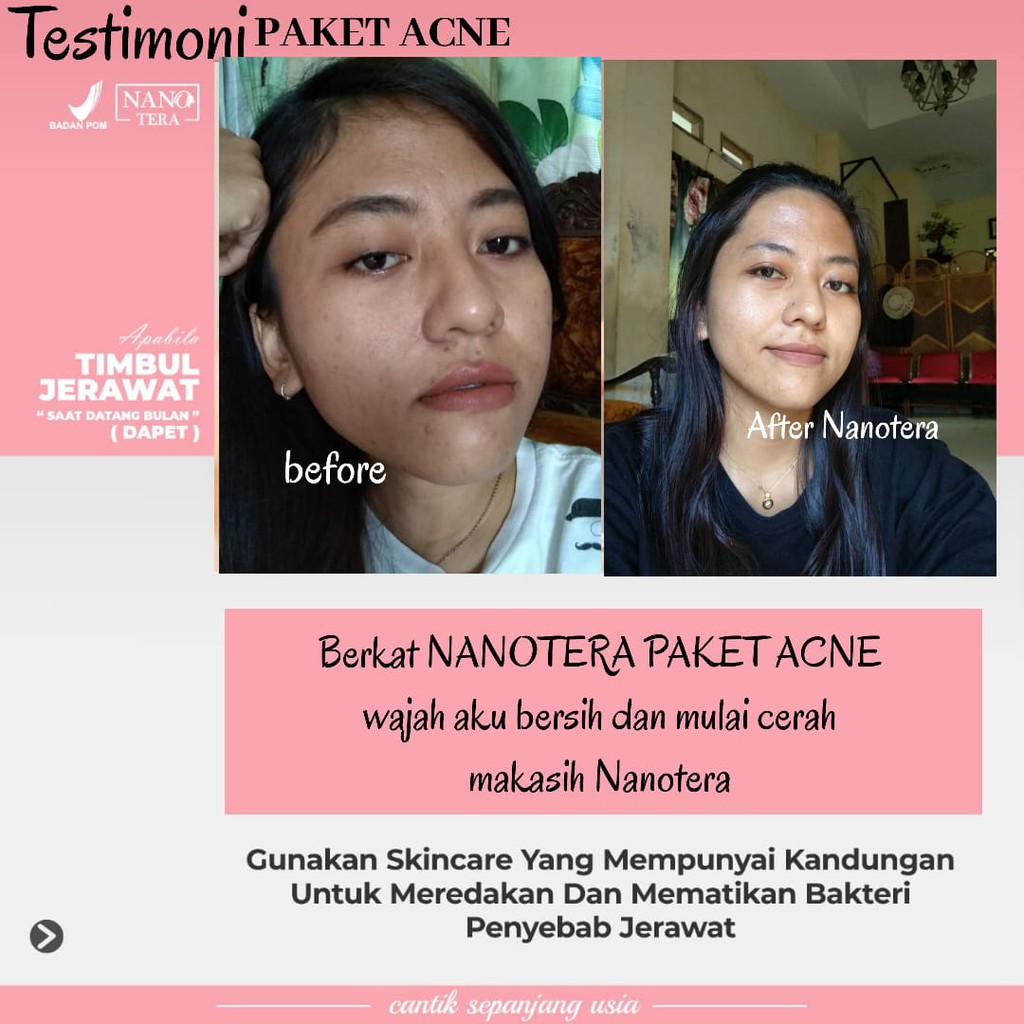 Krim Jerawat Ampuh Paket Acne BPOM  Nanotera Skincare Pria dan Bekasnya Kulit Berminyak Bruntusan-2