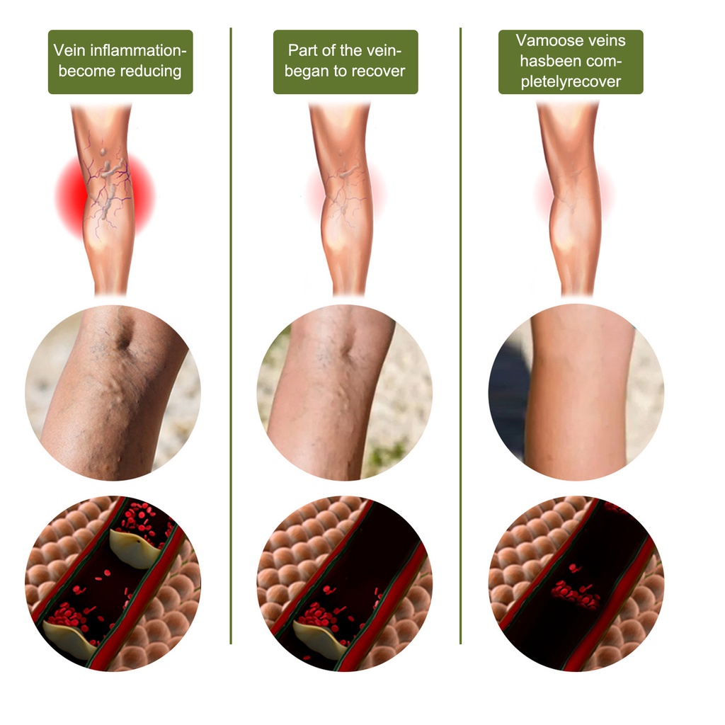 Obat Varises Salep Varises Cream Varicose Veins Varikokel Bengkak Benjolan Buah Zakar Nyeri Testis Vaskulitis Flebitis Pengobatan Vaskulitis Salep