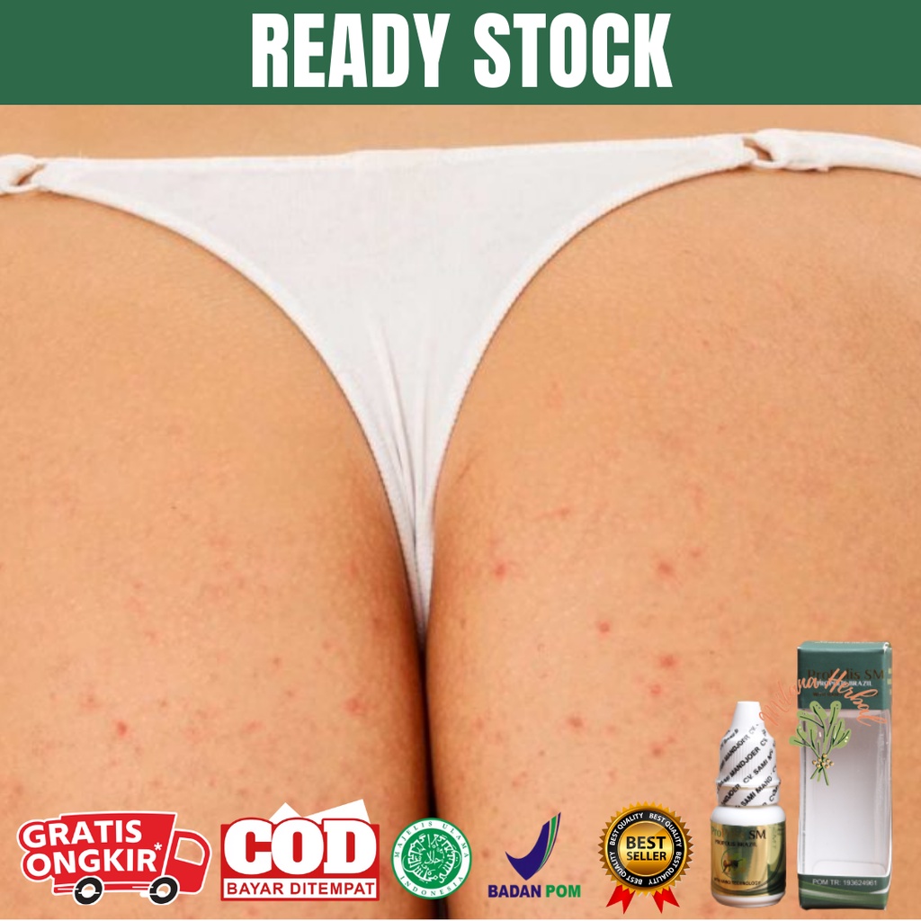 Obat Jerawat Pantat, Obat Pantat Bruntusan, Obat Pantat Gatal, Bintik Merah Pantat, Ruam Pantat, Pen