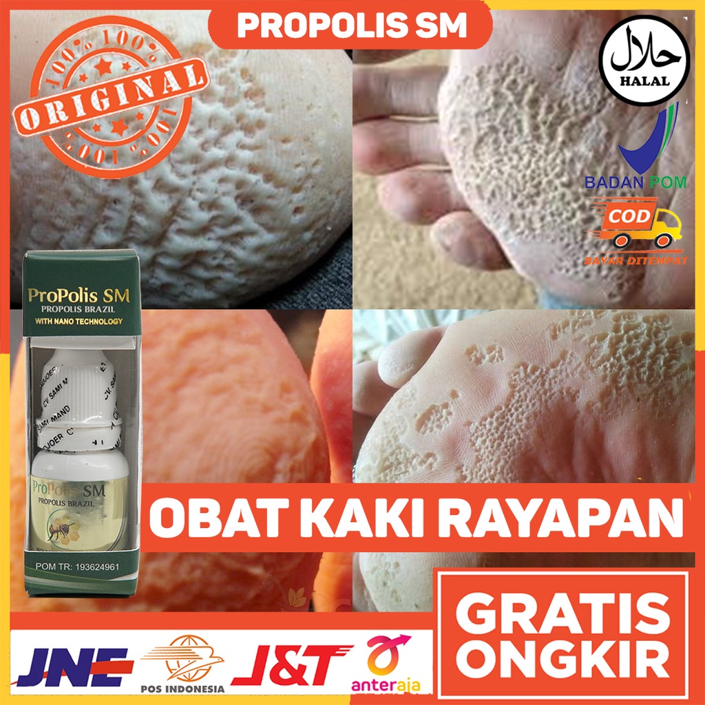Obat Penghilang Kaki Rayapan Kaki Berlubang Obat Mata Ikan Obat Kaki Jamuran Obat Kaki Pecah Pecah