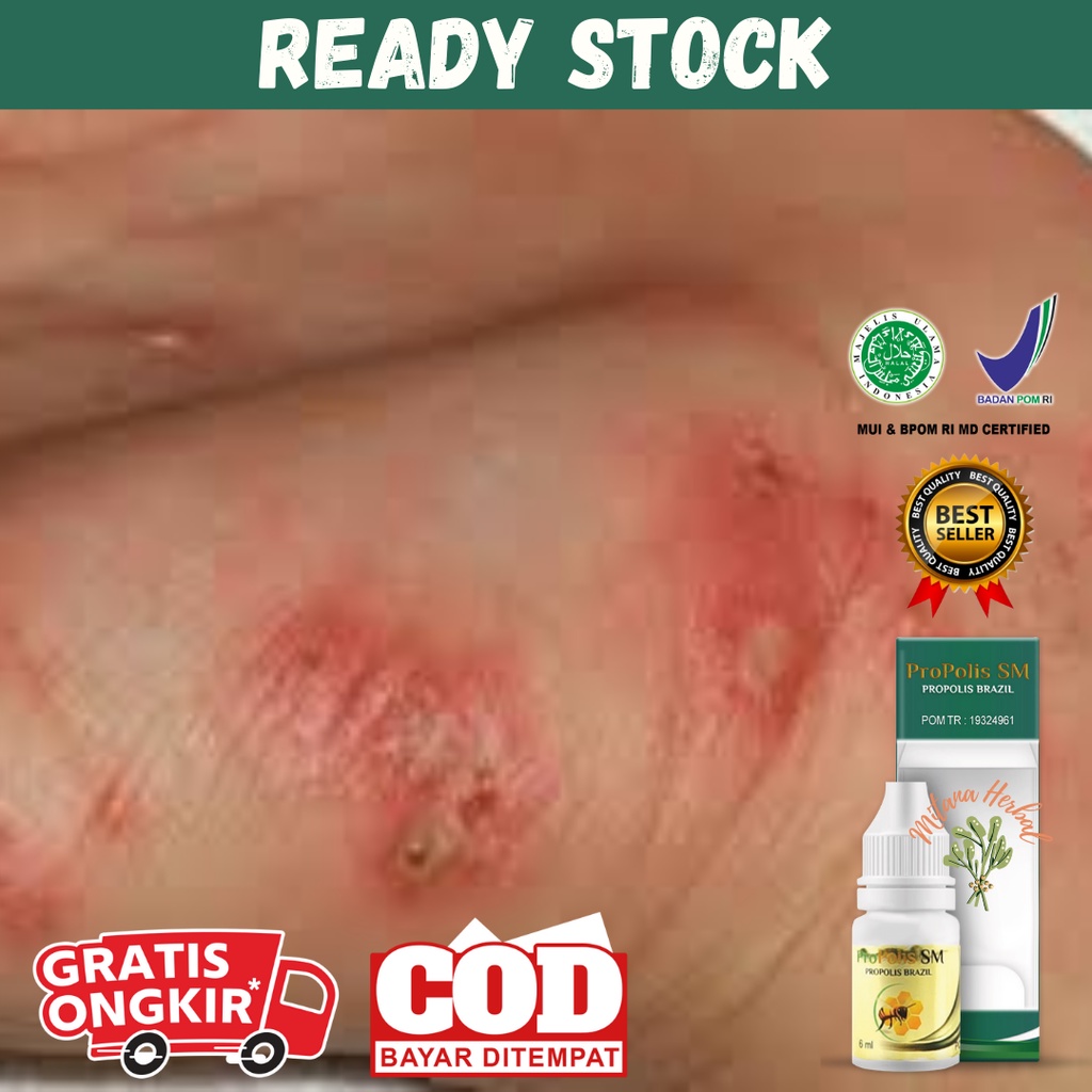 MIAL Obat Oles Penyakit Budug, Borok Di Kaki, Salep Scabies, Pengering Luka Budug, Budug Di Kaki, Ce