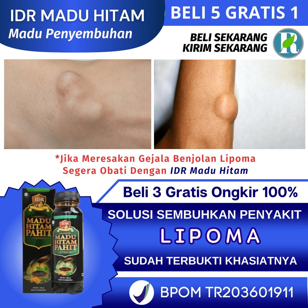 Obat Lipoma - IDR MADU HITAM