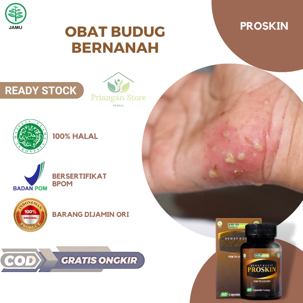 Obat Budug Bernanah, Kudis, Scabies Manusia, Gatal Bernanah di Tangan, Gudik Gatal, Budug Santri, Bu