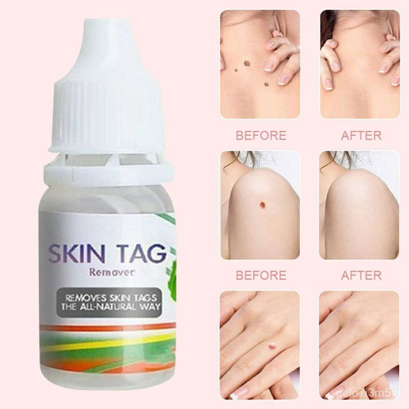 Skin Tag Remover penghilang kutil