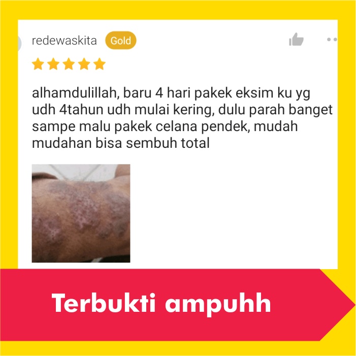 Salep Obat Gatal Eksim Kering Basah Menahun Paling Ampuh Kurap Panu Selangkangan Jamur Gatel Kulit-1