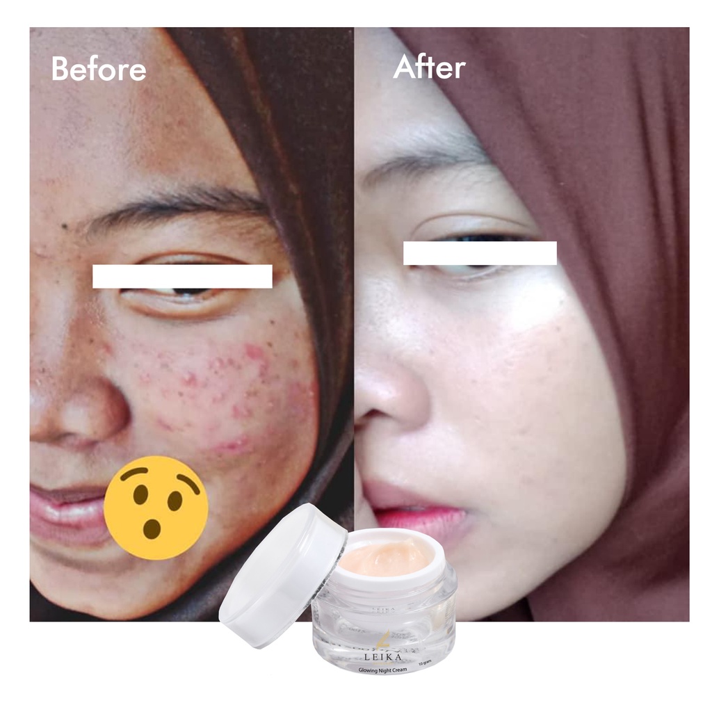 Cream Penghilang Jerawat Penghilang Bekas Jerawat Ampuh! Obat Jerawat dan Bekas Jerawat Obat Jerawat Paling Ampuh untuk Wanita Penghilang Jerawat dan Bekas Jerawat Glowing Night Cream Leika Skincare Resmi BPOM cream wajah berminyak dan berjerawat