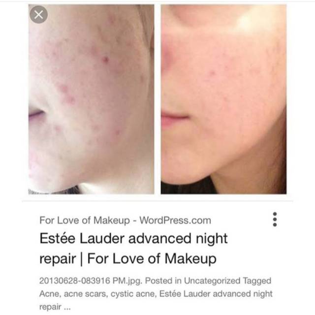 estee lauder serum acne