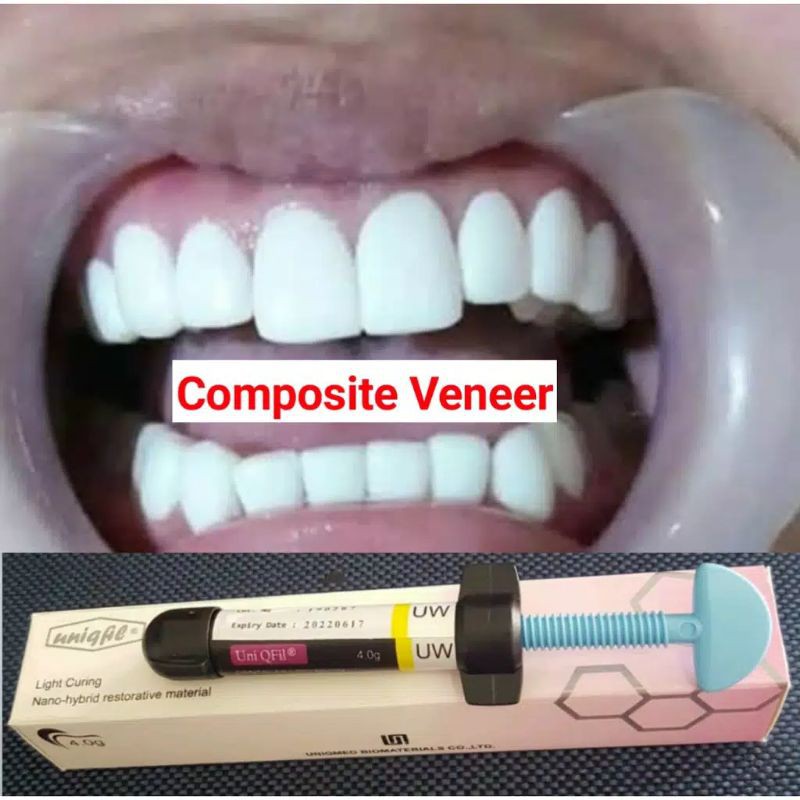 Composite VENEER ultra white / LEM VENEER