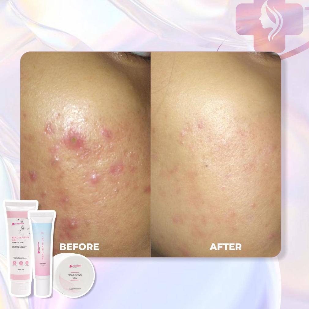 Airnderm Aesthetic Niacinamide Gel Tube (By Airin Beauty)