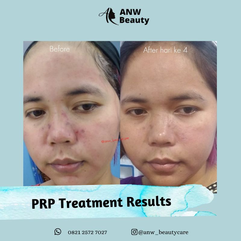 Anw Beauty Prp Treatment Prp Vampire Acne Facial Shopee Indonesia