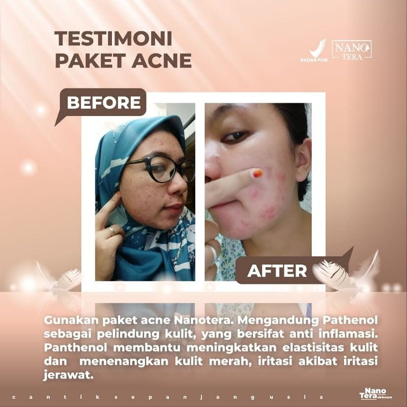 Krim Jerawat Ampuh Paket Acne BPOM  Nanotera Skincare Pria dan Bekasnya Kulit Berminyak Bruntusan-3