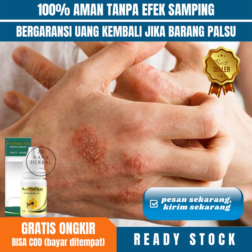 Obat Radang Kulit, Obat Eksim Parah Pada Kulit, Eksim Kering, Eksim Basah, Eksim Menahun, Obat Gatal