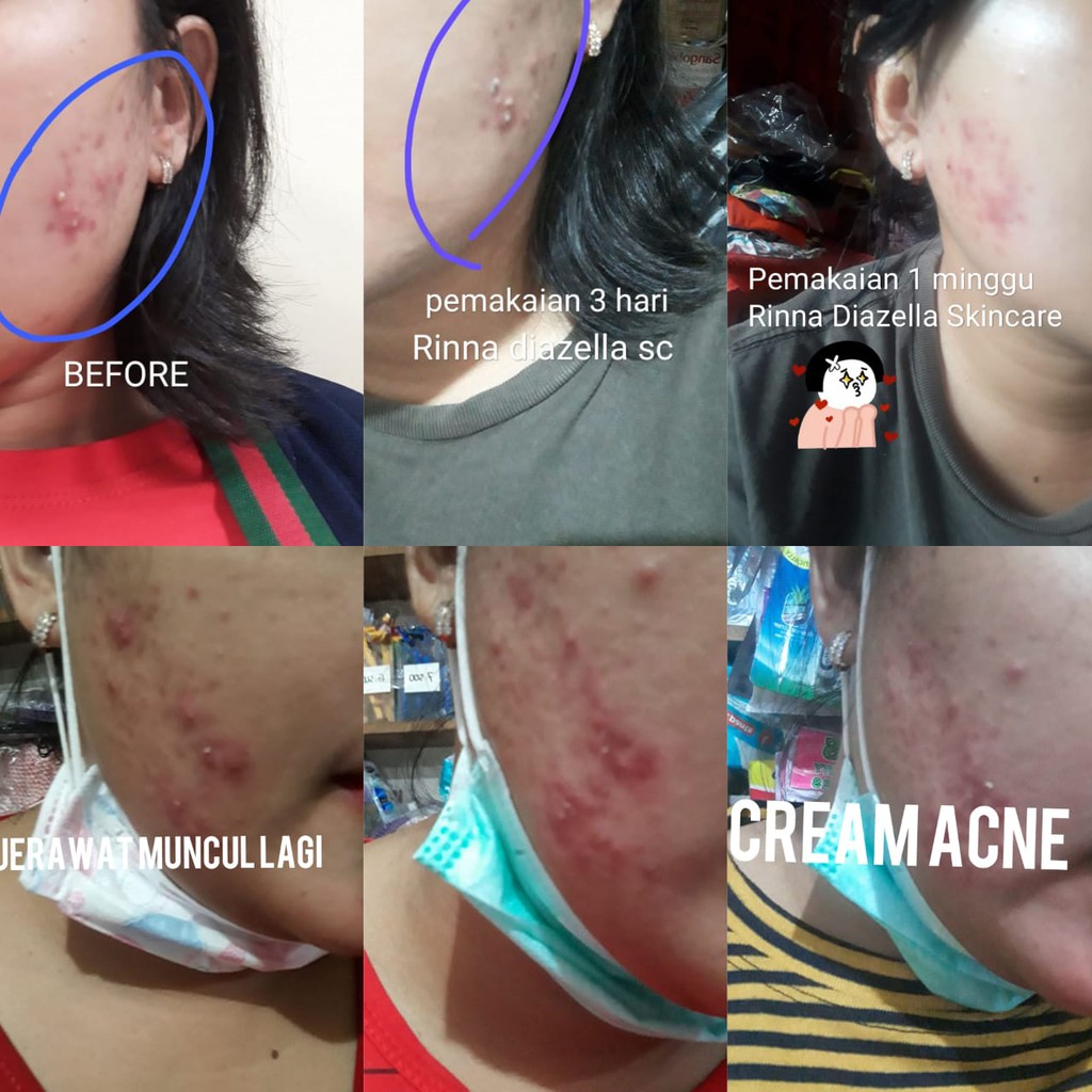 RINNA DIAZELLA ACNE CREAM
