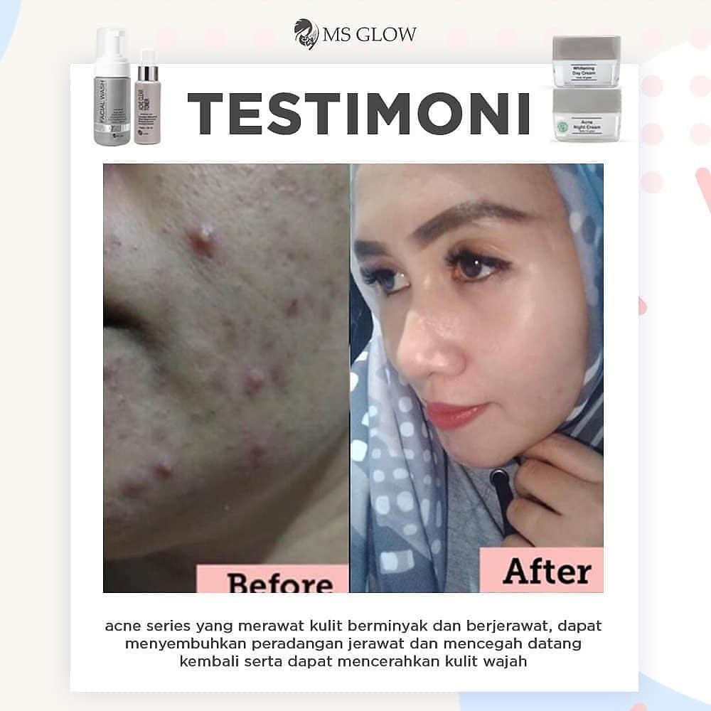 Ms Glow Paket Acne Perawatan Wajah Paket Kecantikan Perawatan Wajah Berjerawat Shopee Indonesia