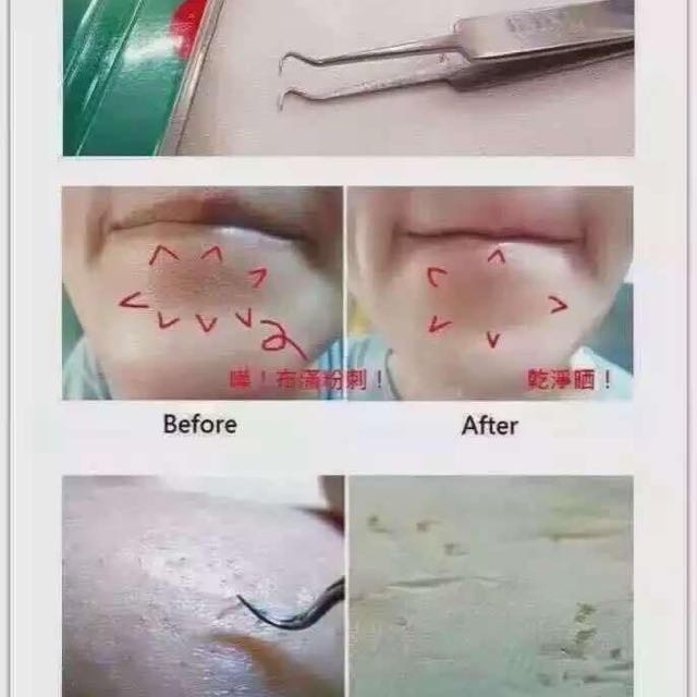 [Ready Stok] Penjepit Komedo Pinset Tweezer Pinset Komedo Japit Komedo Jerawat Hidung Pori - Pori Stainless