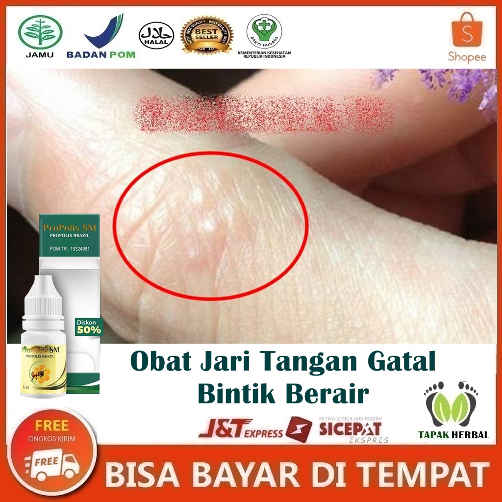 Obat Bintik Berair Di Telapak Tangan, Obat Penghilang Gatal & Bintik Berair Di Telapak Tangan, Obat 