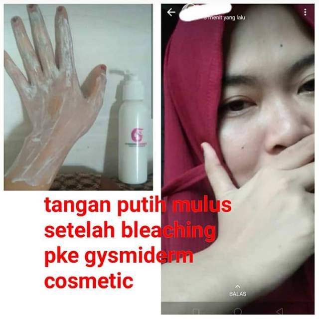 Bleaching gysmiderm