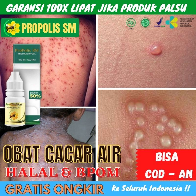 Obat cacar air anak