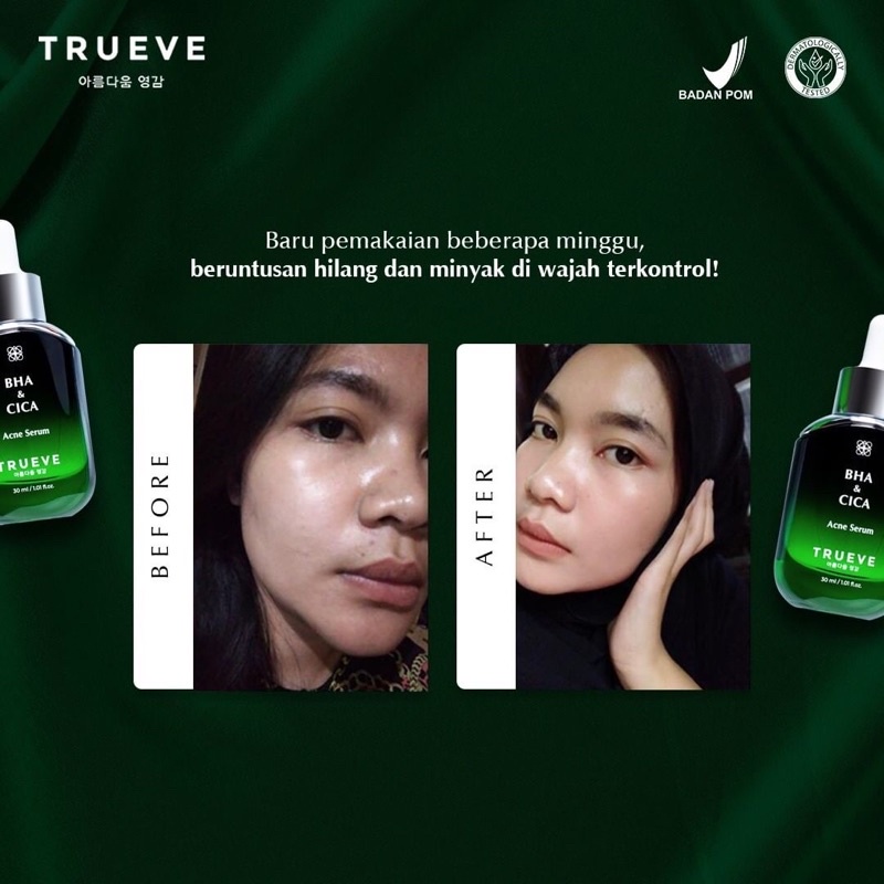 TRUEVE BHA &amp; CICA Acne Serum 30 ML serum wajah