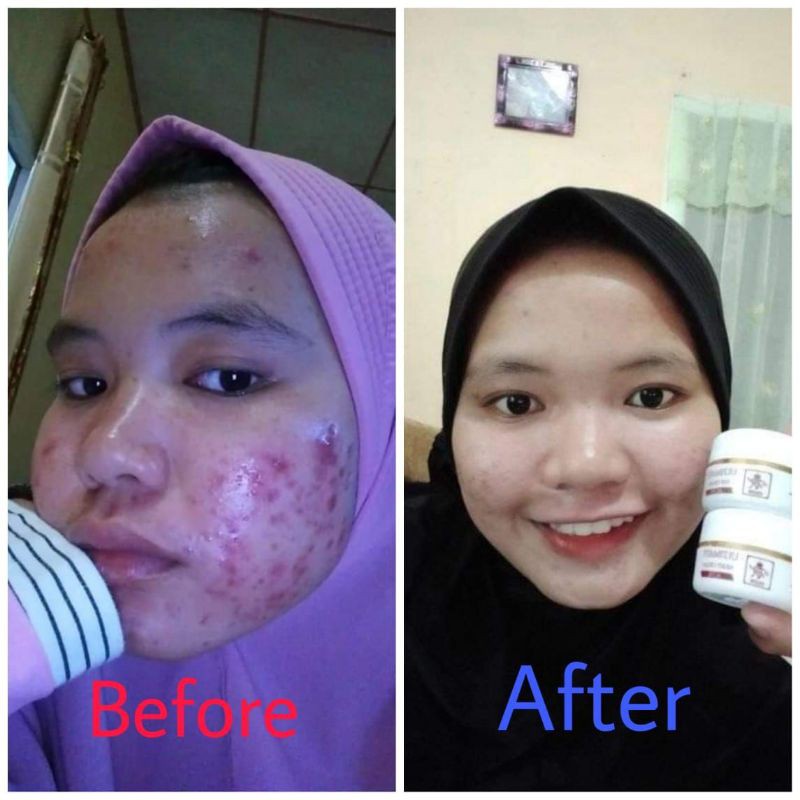 COD - RK GLOW ACNE - PAKET SKINCARE JERAWAT - MENGHILANGKAN ACNE DAN BEKASNYA - MEMBUAT MULUS