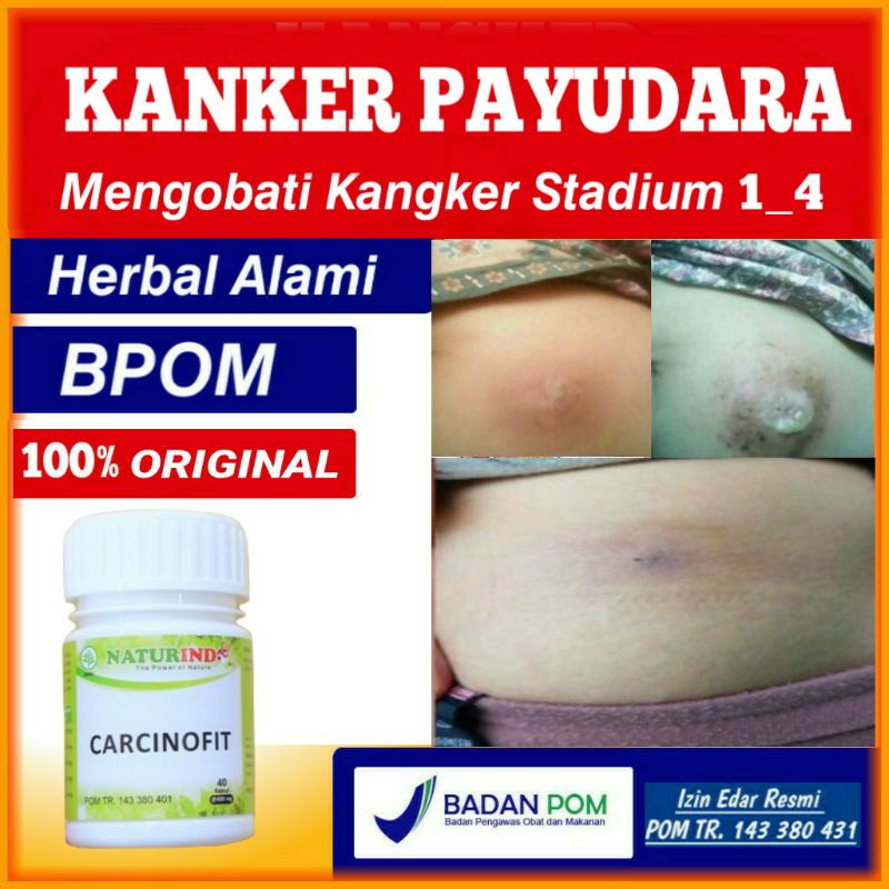 obat kanker payudara kanker otak tanpa operasi CARCINOFIT naturindo
