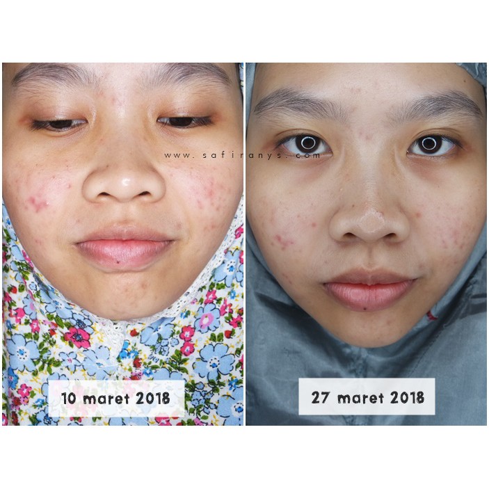 Scarlett  READYY Whitening Acne Serum