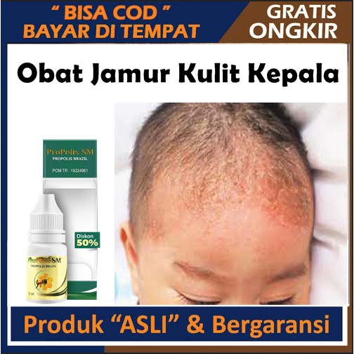 Obat Jamur Kulit Kepala - Tinea Kapitis, Obat Infeksi Jamur di Kepala, Capitis, Propolis SM BRAZIL