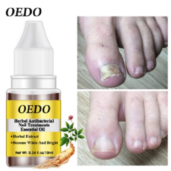 Obat Kuku Antibakteri Jamur Perawatan Kuku Tangan dan Kaki Minyak Herbal Oedo Kuku