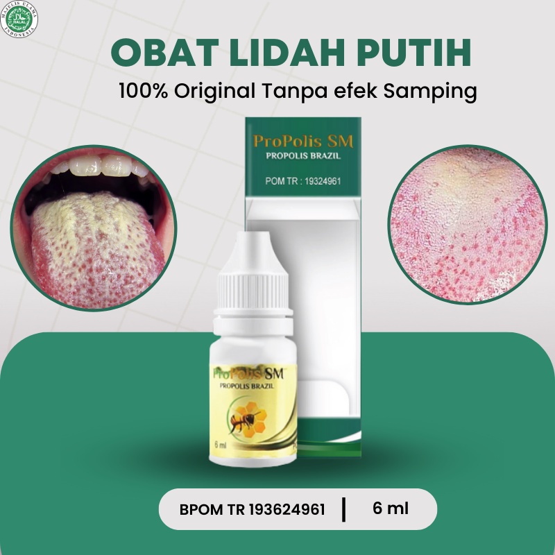 Jual Propolis Sm Obat Lidah Putih Obat Kandidiasis Oral Lidah Pecah