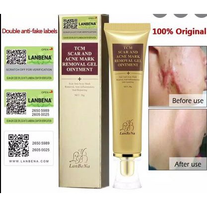 Keloid tcm scar &amp; acne mark removal penghilang bekas luka