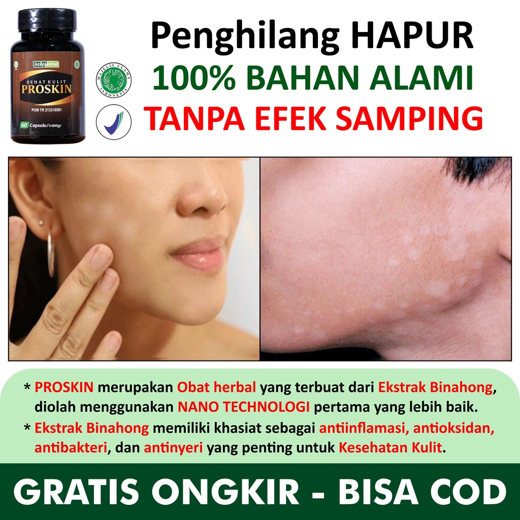 Penghilang Hapur Bercak Belang Putih Gatal Paling Alami untuk Menghilangkan Gatel Kulit Hapuran di P