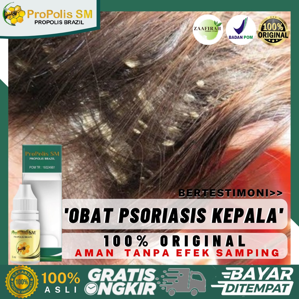 Jual Obat Kulit Kepala Gatal Psoriasis Kulit Kepala Kulit Kepala Berkerak Kepala Berjamur