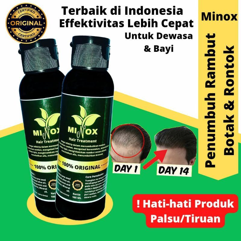 Jual [MINOX] Penumbuh Rambut Botak,Tipis dan Rontok Super Cepat