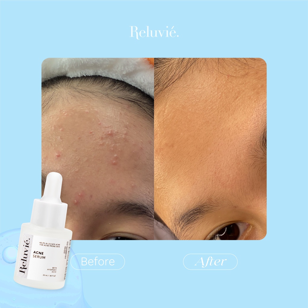 Reluvie Acne Serum-4