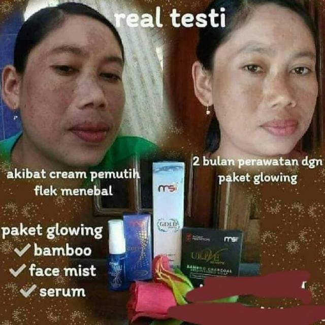 Produk perawatan jerawat by Msi