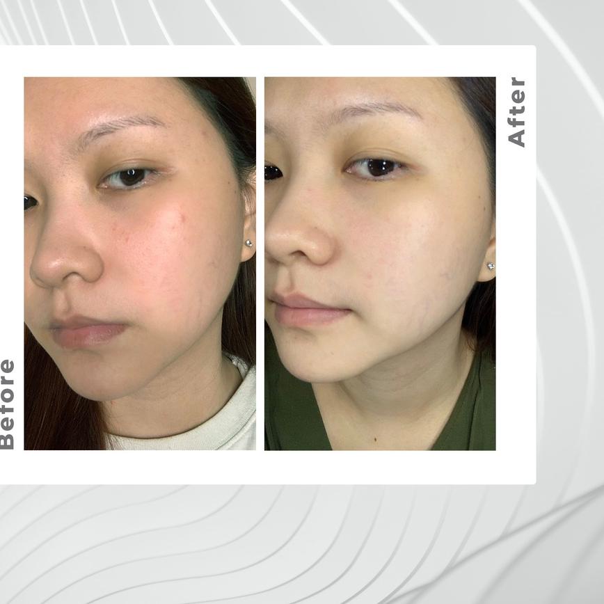 ♦ Reluvie Acne Serum ☈
