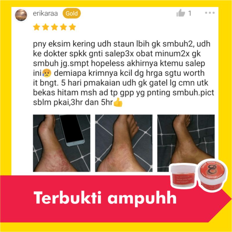 Salep Obat Kurap Kudis Paling Ampuh Gatal Eksim Kutu Air Jamur Kulit Selangkangan Gatel Jerawat Panu-2