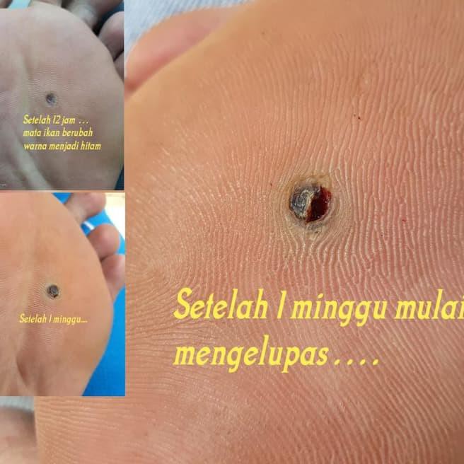 penyakit mata ikan atau clavus bukan plester  callusol KEB