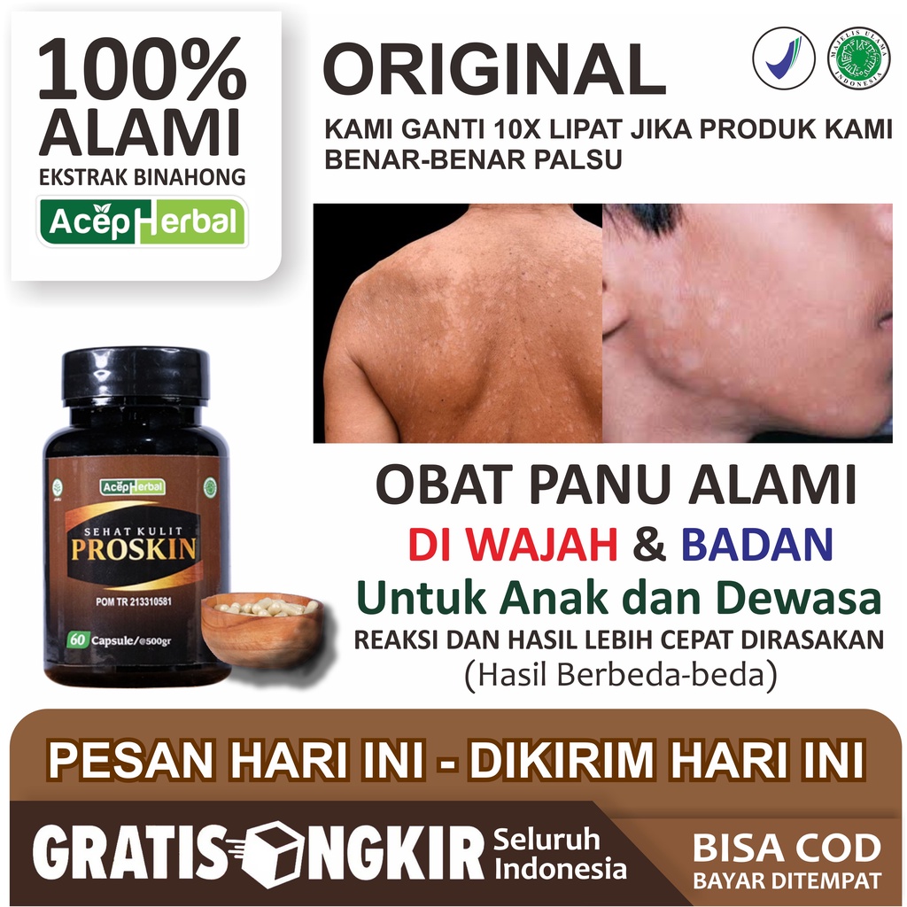 Obat Panu Panau Hapur Gatal Jamur Kulit Paling Alami Suplemen Kesehatan Herbal Penghilang Bercak Bel