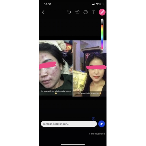 ANZORA PAKET ACNE DARK SPOT