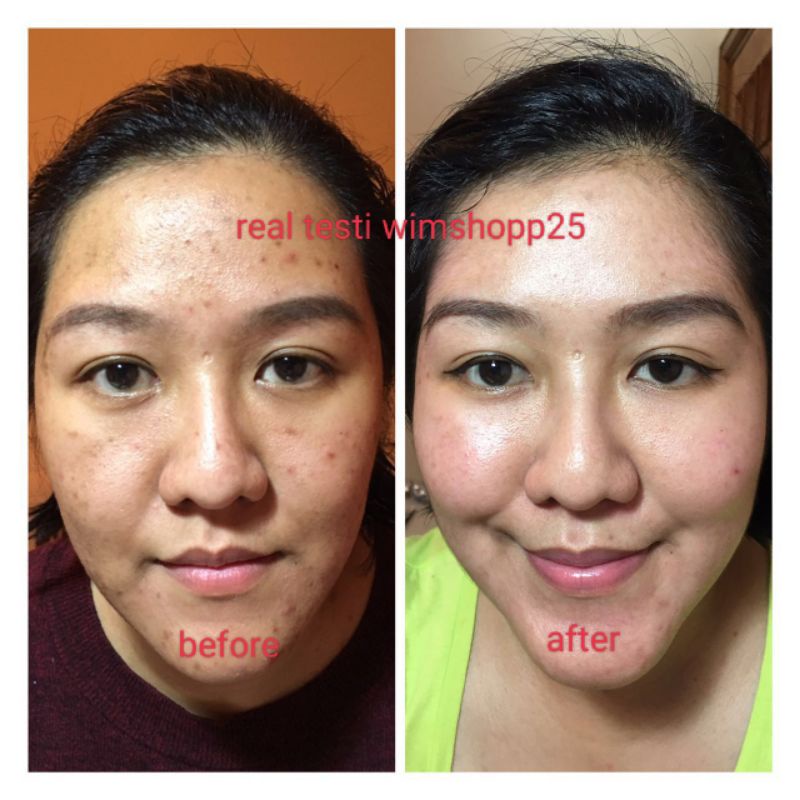 TONER WAJAH KUSUS ACNE/JERAWAT 1LITER